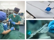 麻醉科开展新技术 ---支气管封堵器成功应用于胸腔镜手术麻醉